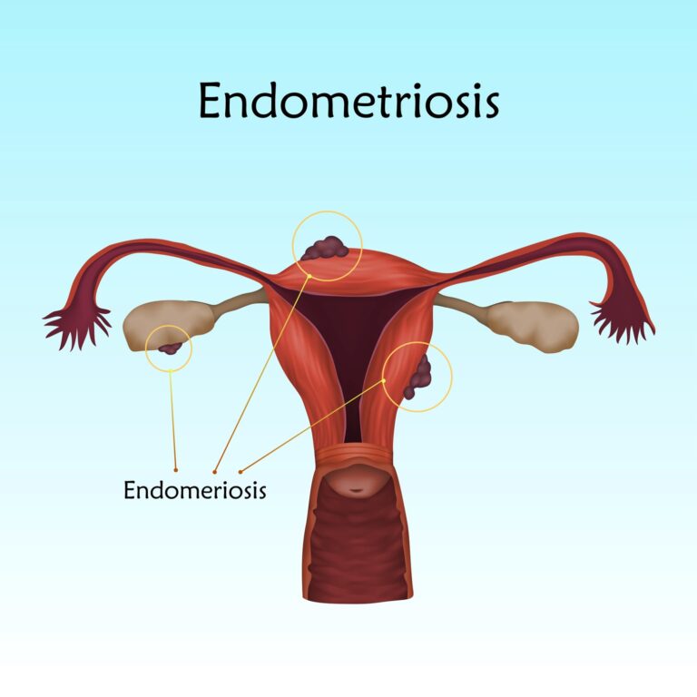 Endometriosis: What You Need to Know?